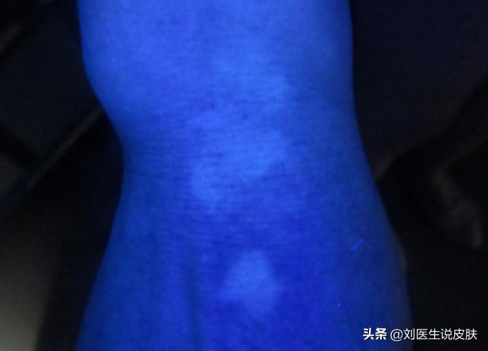 手部的白癜风怎样能治好,手部白癜风怎么治疗最好