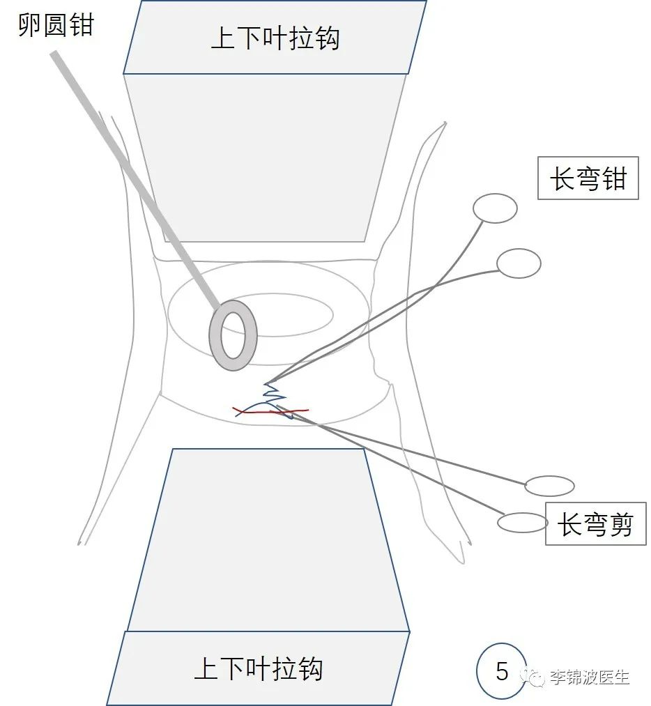 宫颈环扎术的详细步骤,宫颈环扎线拆除多少钱