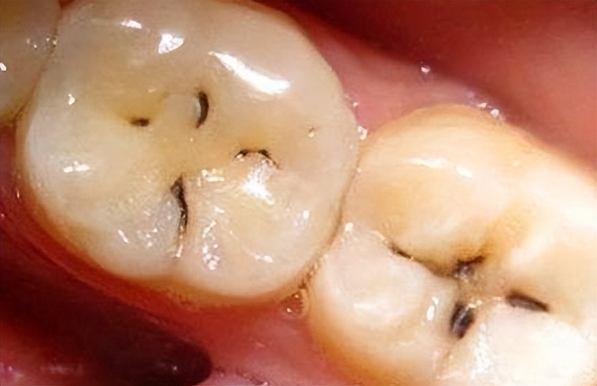 我们的目标是没有蛀牙出处,有没有保护牙齿不蛀牙的办法