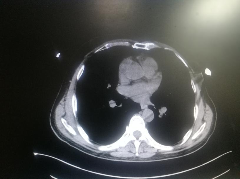 骨折恢复期刺痛怎么缓解,骨折治疗恢复后可能出现的后遗症