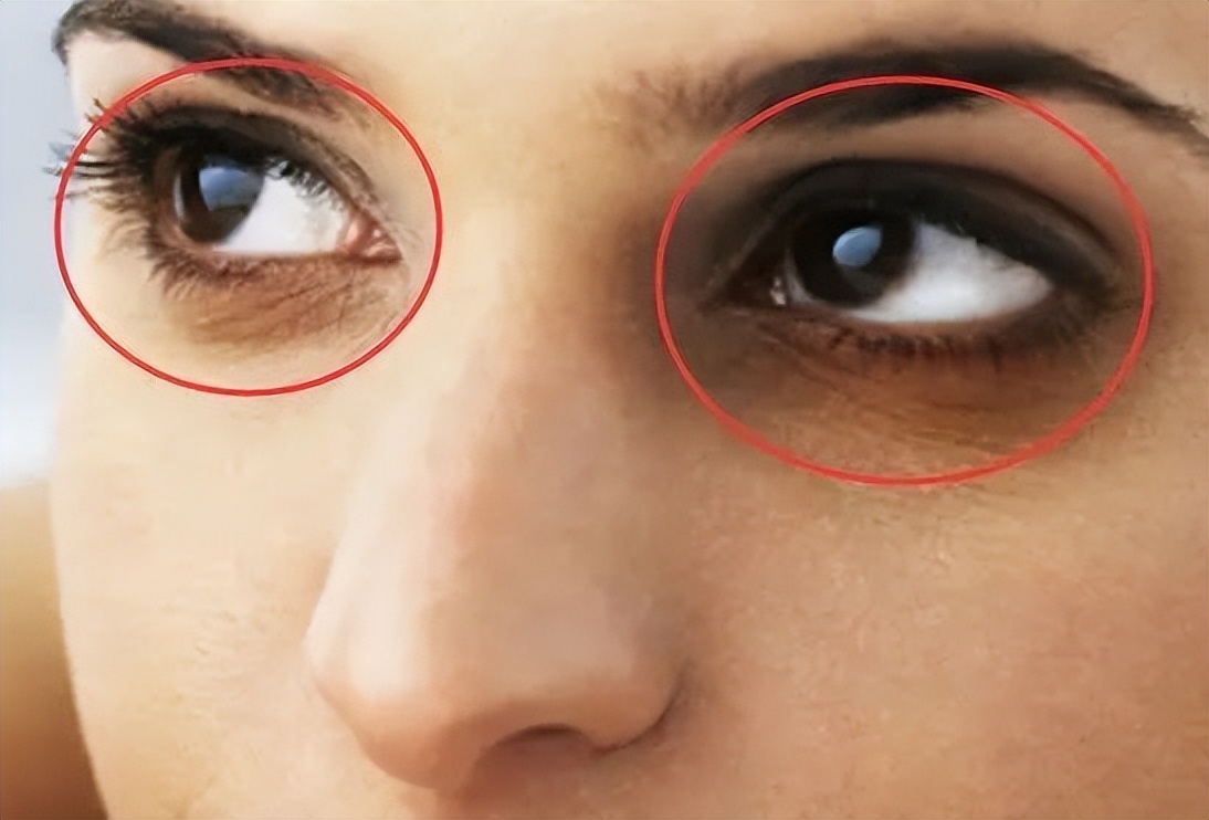 杭州90后姑娘熬夜十年长出老年斑,熬夜造成的老年斑长啥样