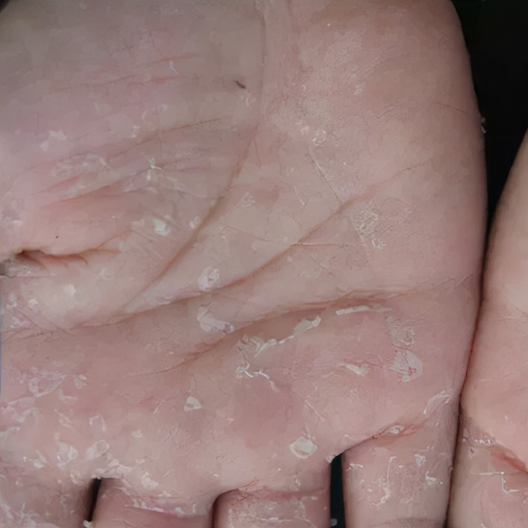 脚底疼是猝死的前兆吗,脚底脱皮是癌症的前兆