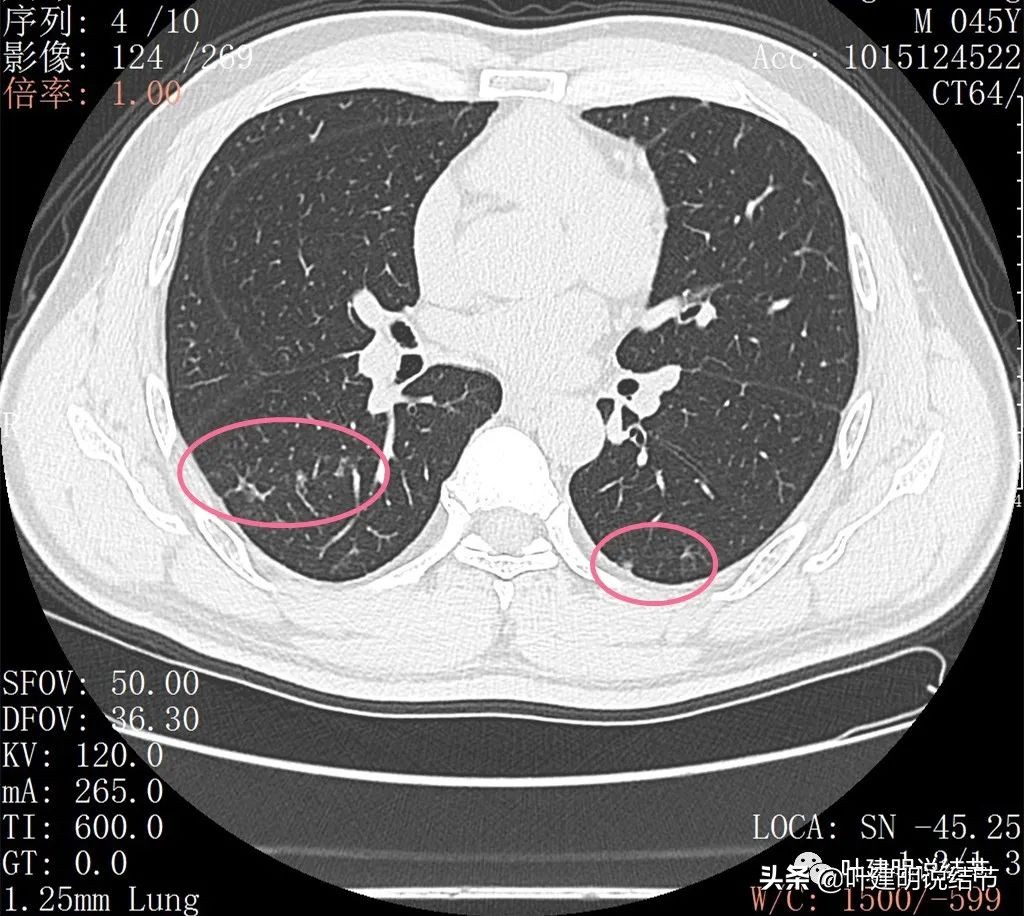误诊肺纤维化,肺蜂窝状是癌吗
