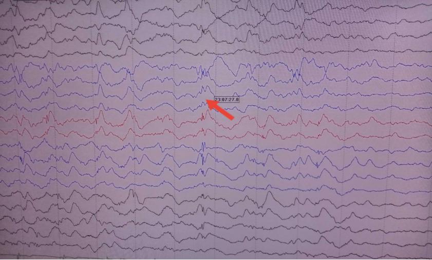 熬夜玩游戏，少年频繁癫痫发作、关节脱臼