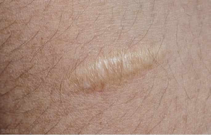 闭合性浅表软组织挫伤,闭合性挫伤处理