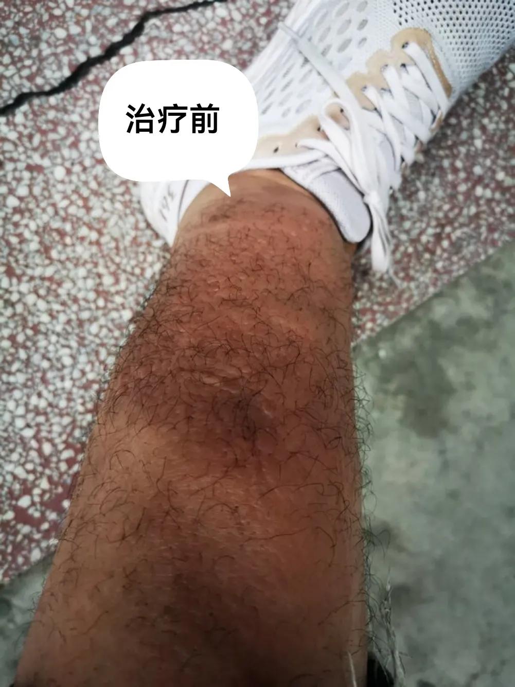 胫前骨粘液性水肿局部治疗,胫前粘液性水肿病例