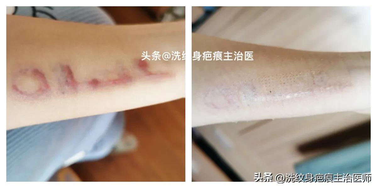 眼袋手术疤痕增生怎么办,剖腹产疤痕增生怎么办