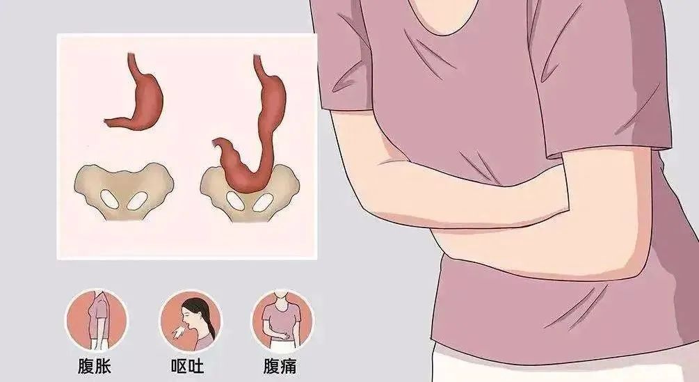 暴饮暴食导致胃下垂怎么办,暴饮暴食胃严重下垂怎么办