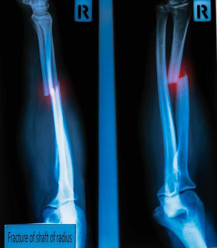 骨折后怎样保养才能消除损伤疼痛,骨折后保守治疗要注意什么