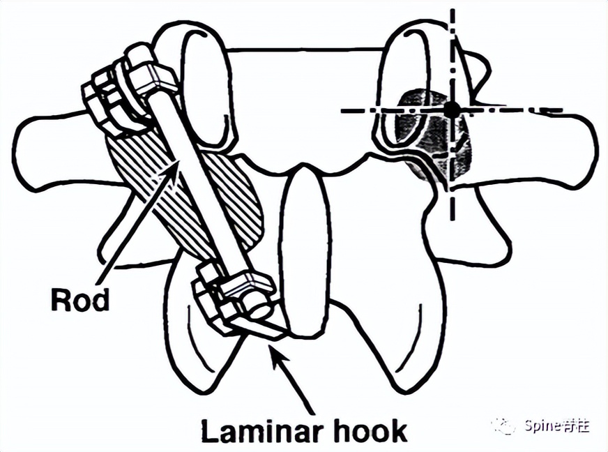 峡部裂和隐性峡部裂有区别吗,单纯峡部裂可以做峡部修复吗