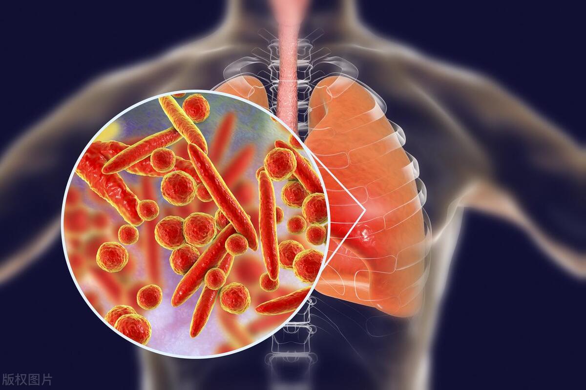 肺炎支原体吃啥止咳药物好,儿童支原体肺炎最有效的抗生素