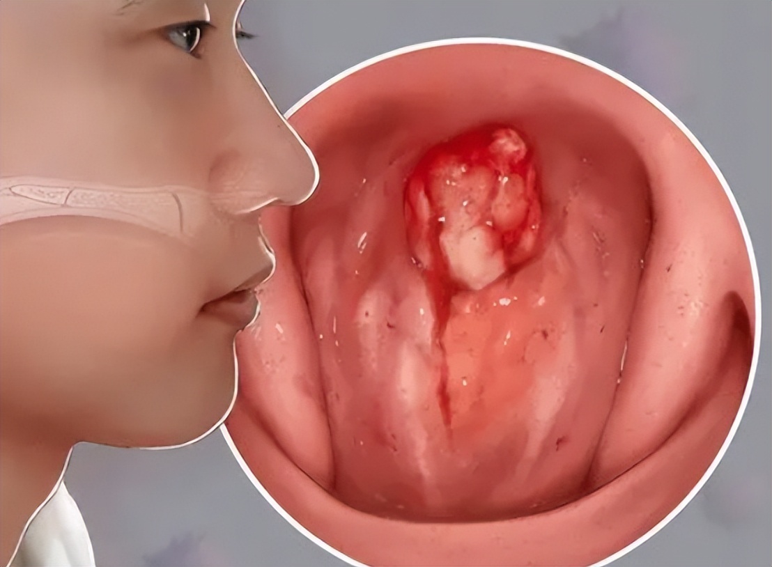 分泌性中耳炎是什么，为什么儿童得病几率更大，要怎么治疗