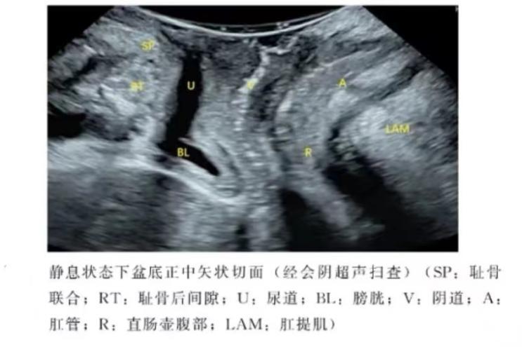 关爱女性健康从关爱女性盆底开始,关爱女性盆底健康图片
