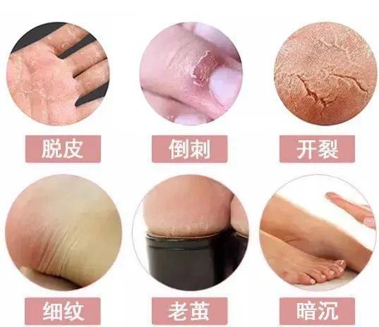 又到了脚气高发的时候，烦人的脚气，到底有没有办法治好？