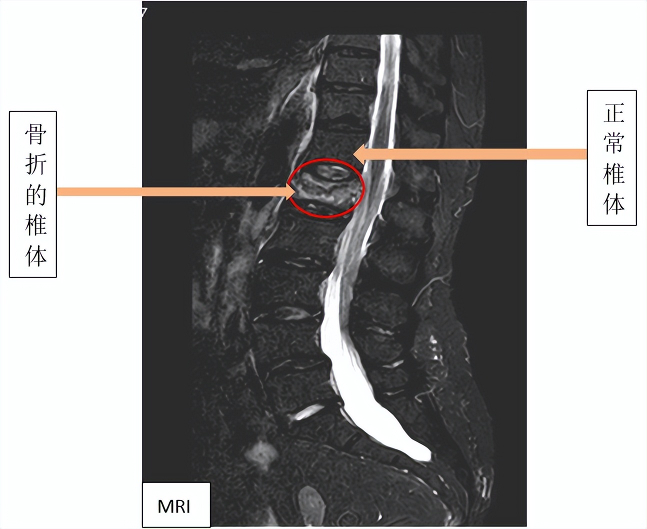 胸腰椎压缩性骨折特色治疗方法,老年人胸腰椎骨折怎么治疗