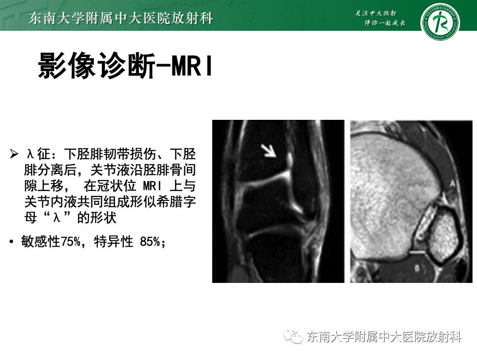 左腓骨下段骨折伴下胫腓联合分离,好文分享深度揭秘