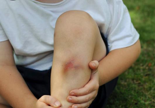 孩子磕碰到怎么安慰,小孩子划伤后有痕怎么处理