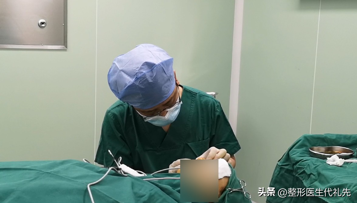 40岁去眼袋手术后效果,外切眼袋手术失败后二次修复