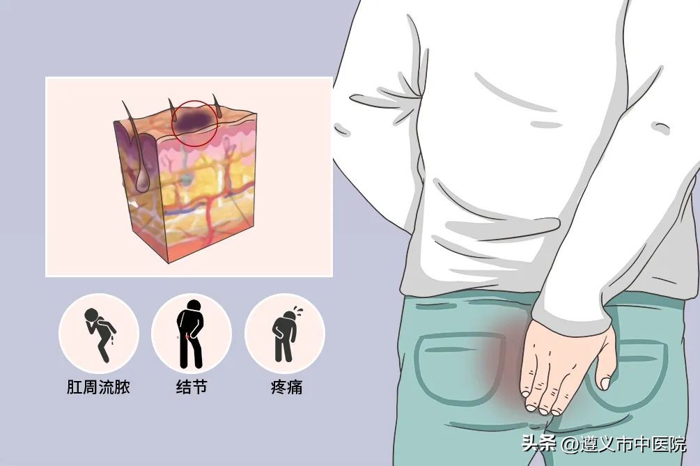 肛周化脓性汗腺炎的中医诊疗,肛周汗腺炎最快自愈方法