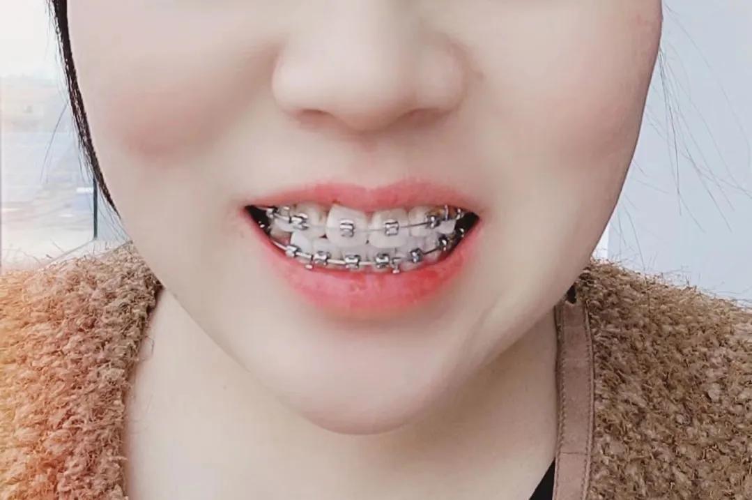 30岁牙齿缺失再矫正的弊端,30岁牙齿不齐怎么矫正