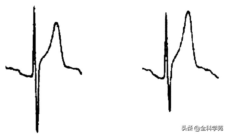 t波高尖心电图判断标准,t波高尖判断标准