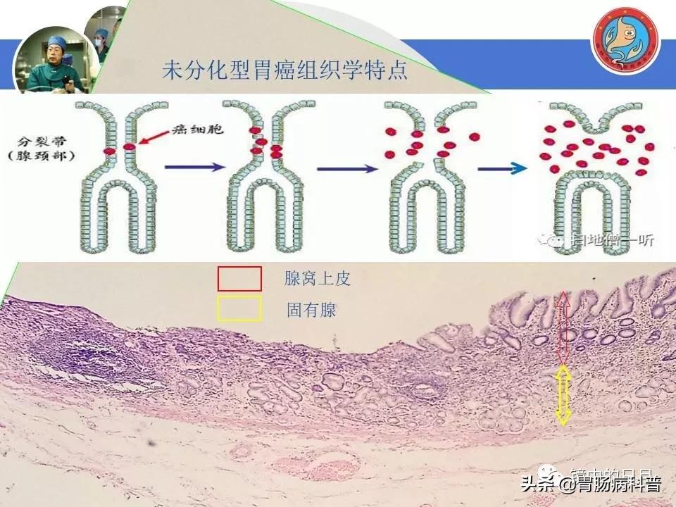 胃癌可以做内镜手术吗,早期胃癌内镜手术后追加外科手术
