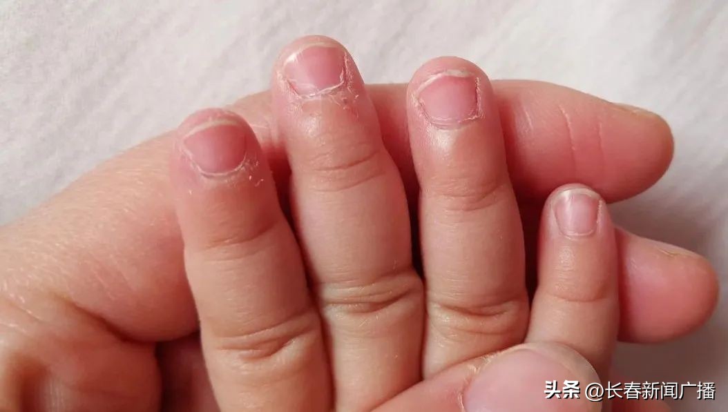 孩子手指起皮长倒刺缺什么,儿童手指总是起皮长倒刺怎么解决