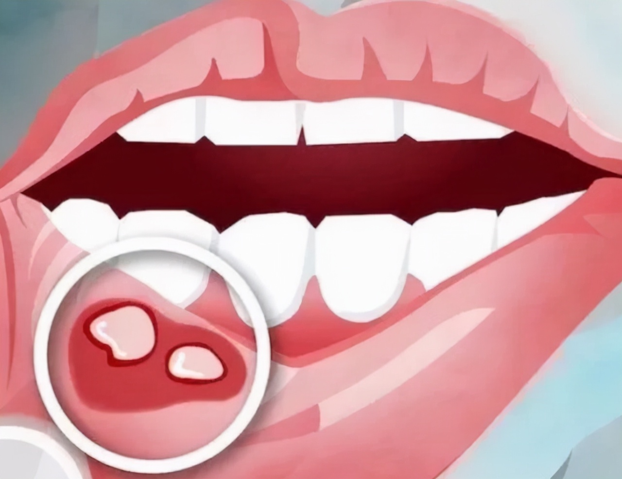 口腔癌早期症状是腮帮子酸牙有味,口腔癌早期治疗费用大概得多少钱