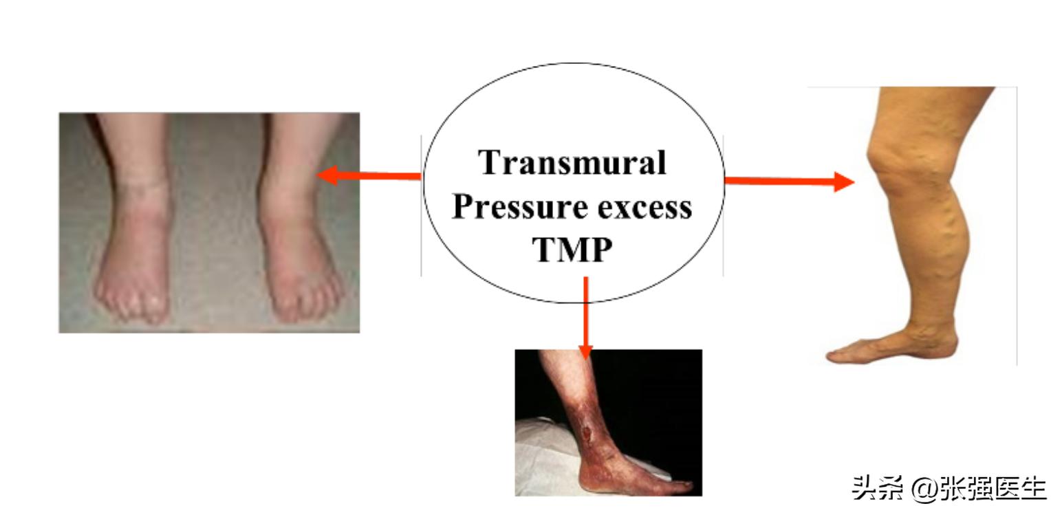 静脉曲张引起小腿肿胀如何治疗,静脉曲张小腿是非凹陷性水肿吗