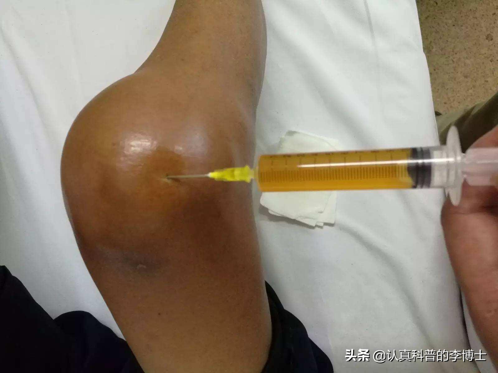 关节有积液需要抽吗,抽关节积液有什么危害