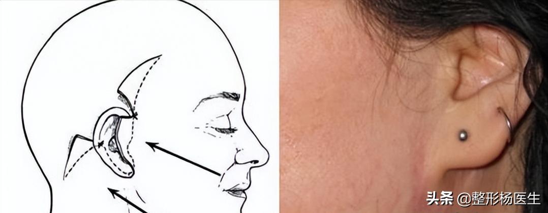 拉皮手术危险有真相,做拉皮手术后遗症