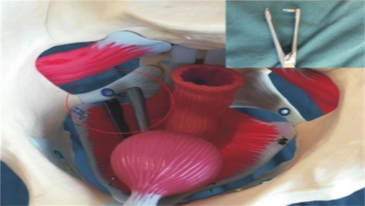 阴挺的病因与治疗,阴挺的含义