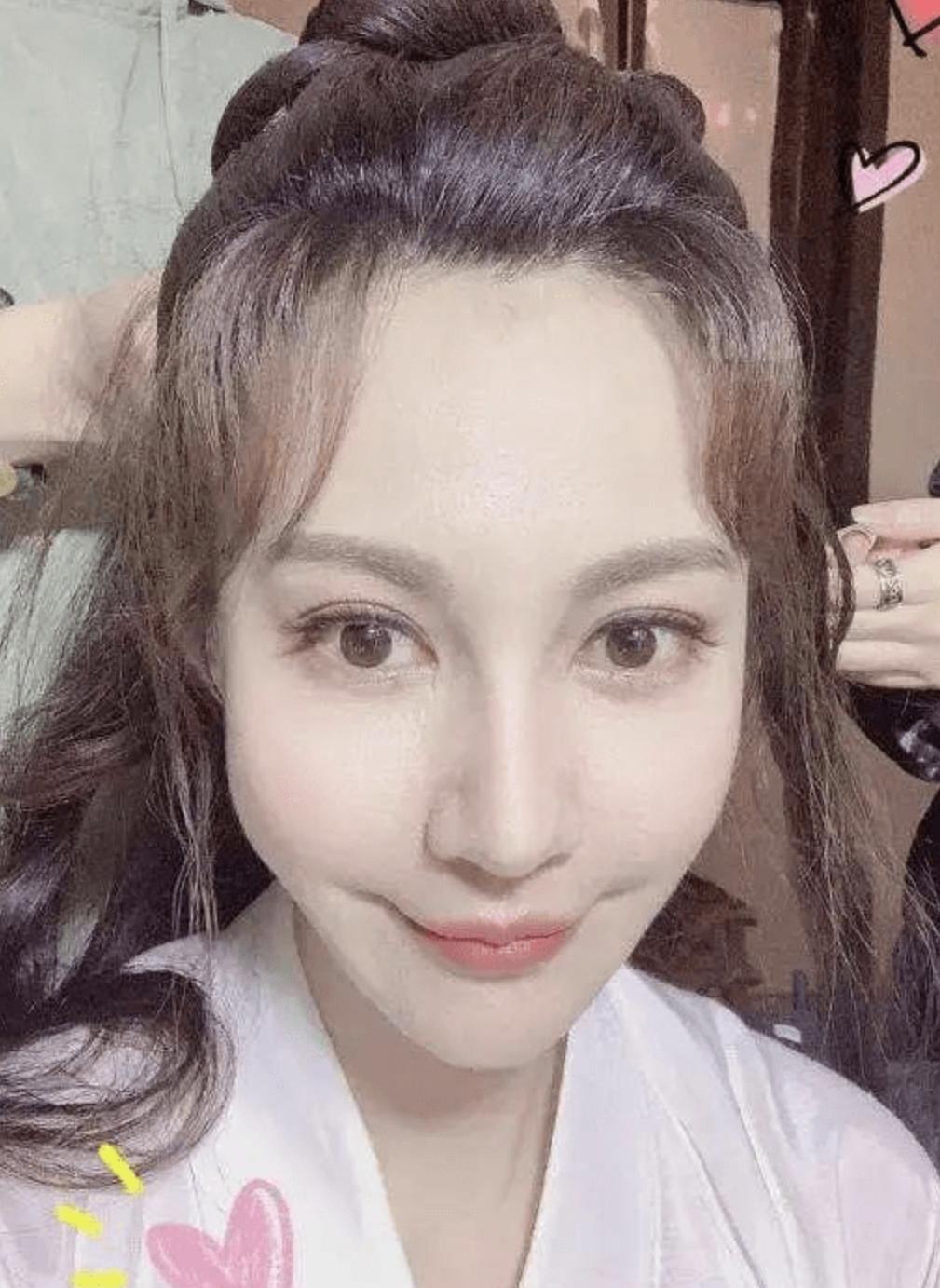 老演员整容脸变形,老年人整容前后照片