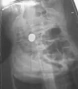 宝宝误吞硬币妈妈急救,宝宝吞硬币海姆立克急救法