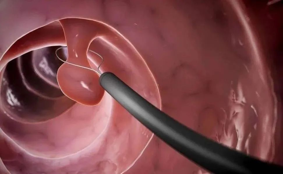 出血不止有血块是什么原因,排卵期出血跟子宫内膜息肉有关吗