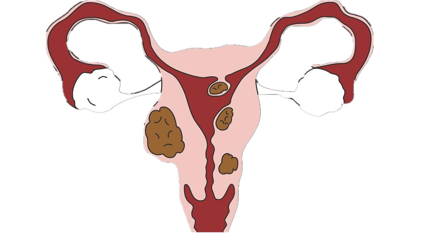 子宫肌瘤就是“纸老虎”！桂枝茯苓丸做基本方，各类肌瘤都可消