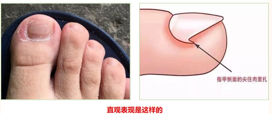 嵌甲危害大，防止有方法