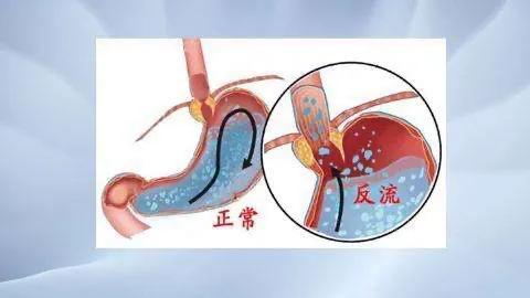 新乡市潘医生说消化科反流性食管炎
