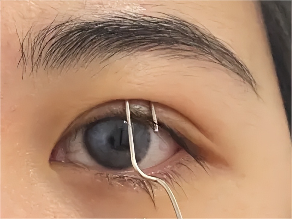 双眼皮手术后眼睛淤紫怎么消除,双眼皮术后眼头紧绷有细纹