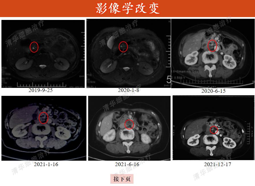 胰腺癌有突破10年的吗,一旦确诊胰腺癌还能活多久