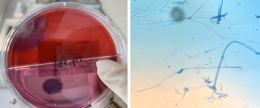 免疫缺陷病会并发什么病,什么是免疫缺陷肺部感染