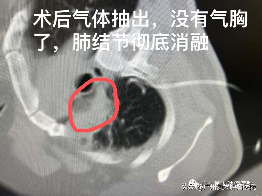 肺结节在内部如何切除,肺气管结节怎么治疗效果最好