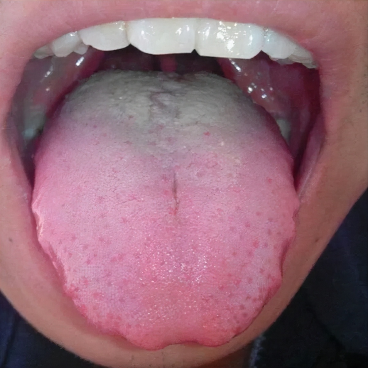 中医四诊中的正常舌象,中医看舌象准还是摸脉准