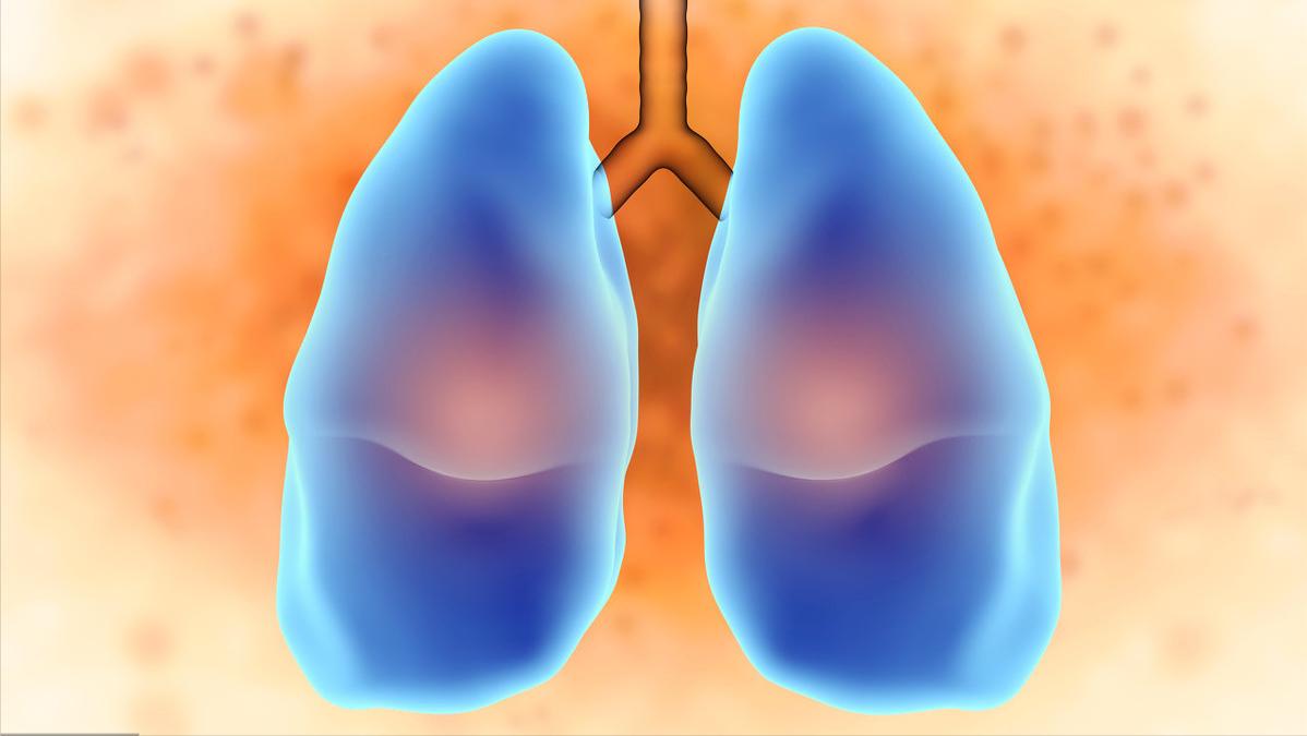 得了肺大泡怎么办,体检有肺大疱