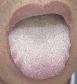 鼻甲肥大鼻塞的最佳治疗药,鼻息肉鼻塞最好的治疗方法