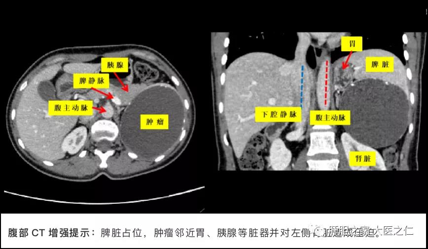 南昌大学二附院肝胆胰外科王恺教授团队为一例“脾脏巨大囊性占位”患者成功实施了腹腔镜下脾脏部分切除手术