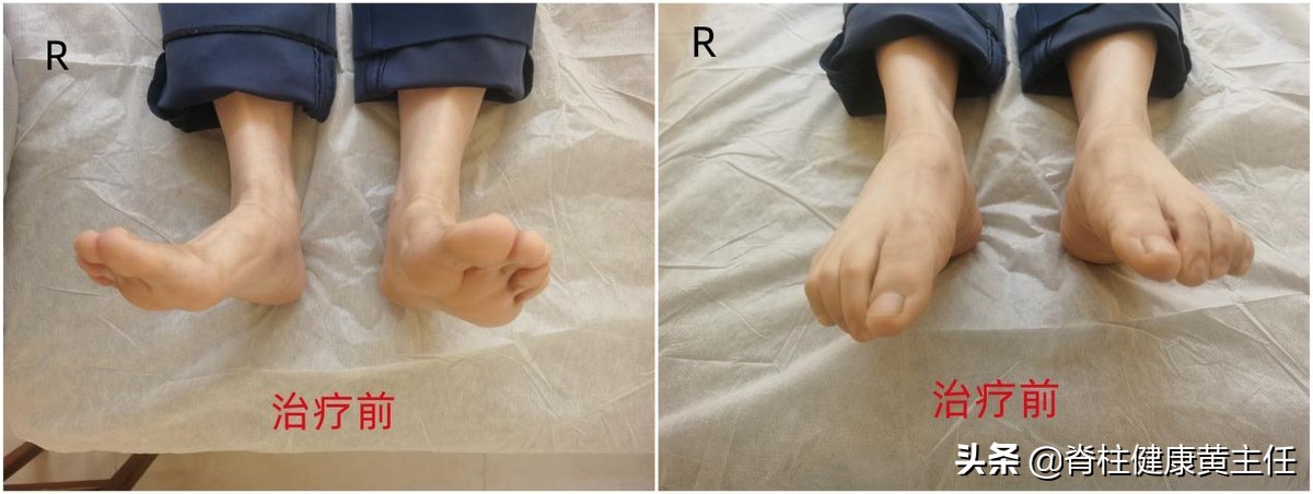 大体重造成的踝关节损伤怎么治疗,踝关节韧带损伤疼痛怎么治疗