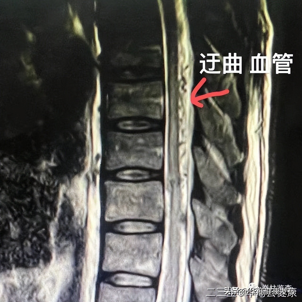 下肢无力一定是腰突引起的吗,腰椎硬脊膜瘘的症状和治疗