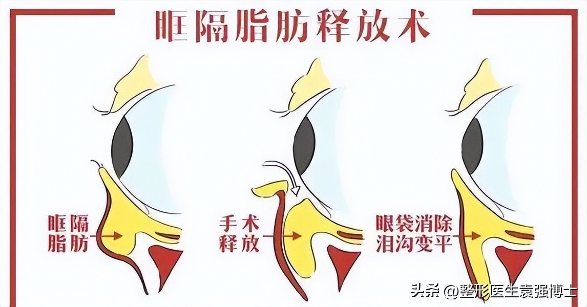 如何解决眼周衰老症状,眼周肌肤出现衰老怎么办