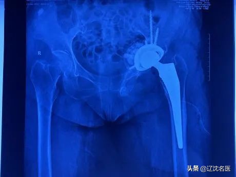 人工髋关节翻修3d打印,大连医院骨科3d打印